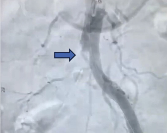 Técnica angiográfica de urgencia con OEC ONE Vascular.