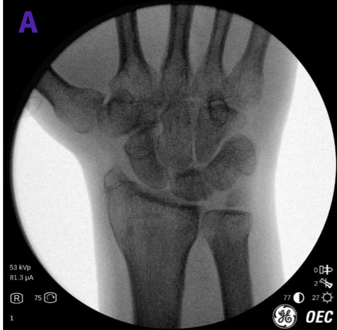 Reconstrucción del ligamento escafolunar, cirugía mínimamente invasiva con OEC Miniview en Clínica Indisa