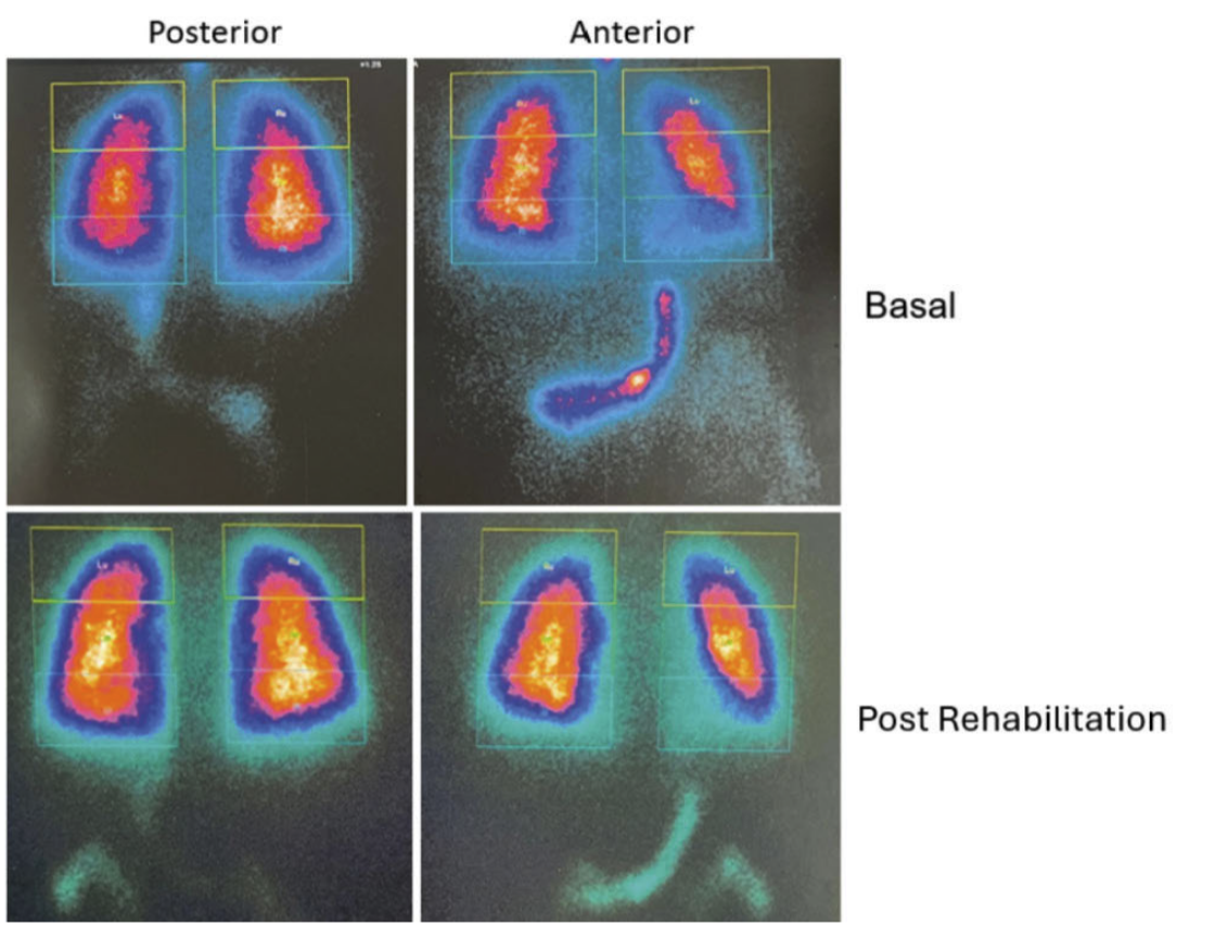 Importance of V/Q Scintigraphy in the Diagnosis and Monitoring of Post-COVID-19
